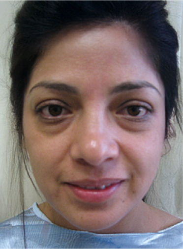 Stem Cell Lift patient before treatment