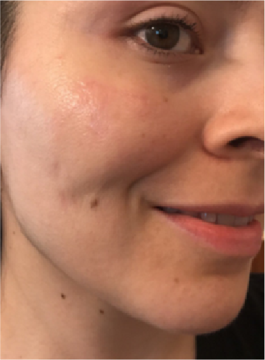 Scar Revision 1 after