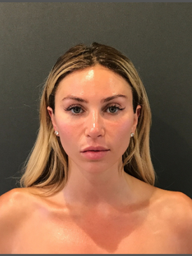 Stem Cell Facial 2 after