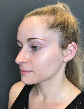 Stem Cell Facial 3 after