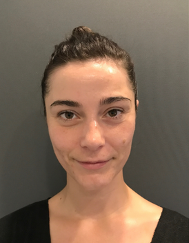Stem Cell Facial 5 after
