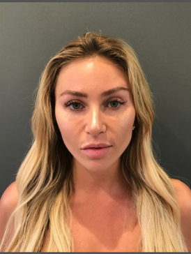 Stem Cell Facial 2 before
