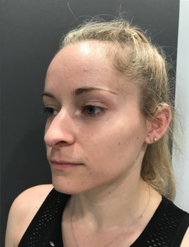 Stem Cell Facial 3 before