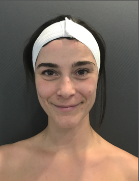Stem Cell Facial 5 before