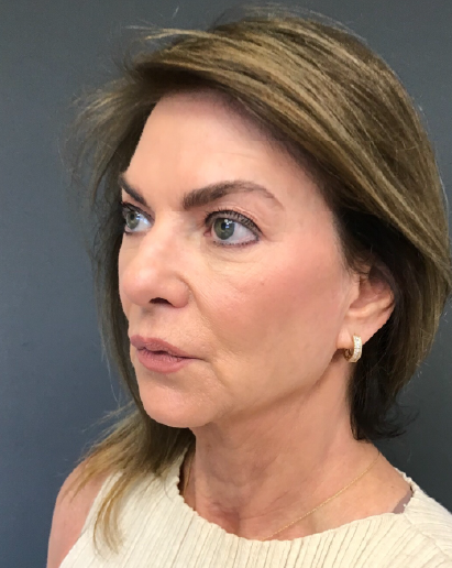Stem Cell Lift case 2 after