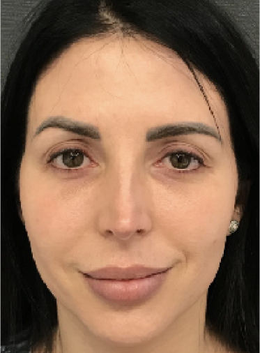 Stem Cell Lift case 12 after