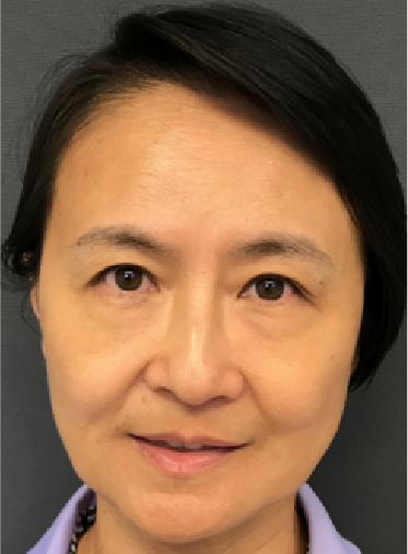 Stem Cell Lift case 13 after