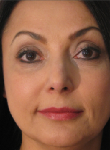 Stem Cell Lift case 15 after
