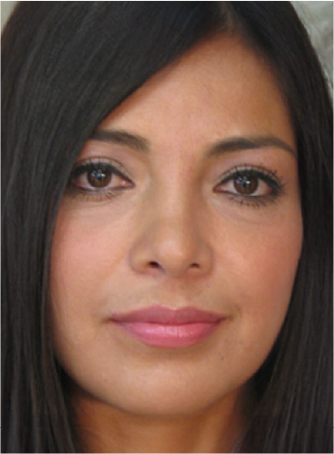 Stem Cell Lift case 16 after