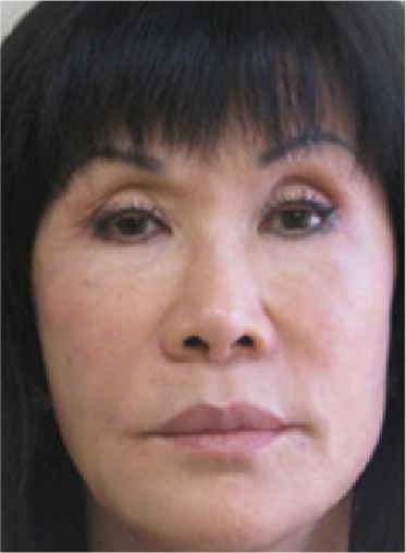 Stem Cell Lift case 17 after