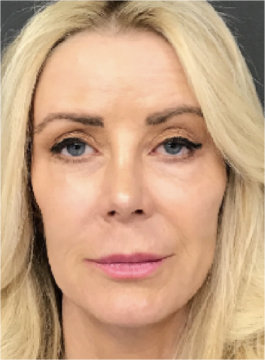 Stem Cell Lift case 18 after