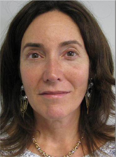 Stem Cell Lift case 6 after
