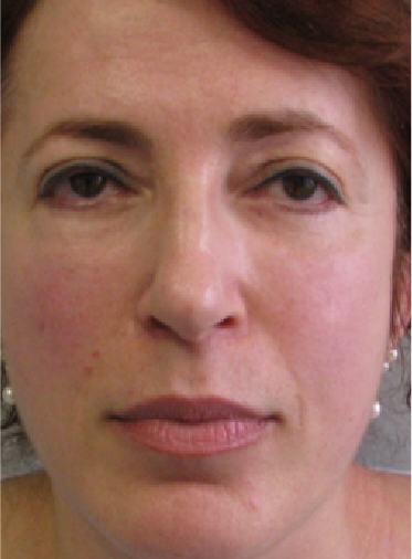 Stem Cell Lift case 8 after