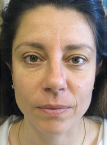 Stem Cell Lift case 9 after
