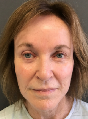 Stem Cell Lift case 10 after