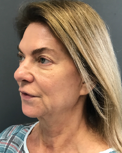 Stem Cell Lift case 2 before