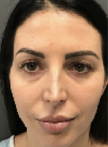 Stem Cell Lift case 12 before