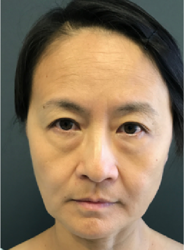 Stem Cell Lift case 13 before
