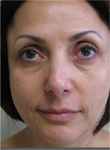 Stem Cell Lift case 15 before