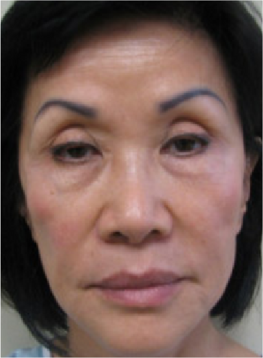 Stem Cell Lift case 17 before