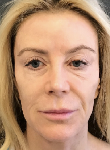 Stem Cell Lift case 18 before