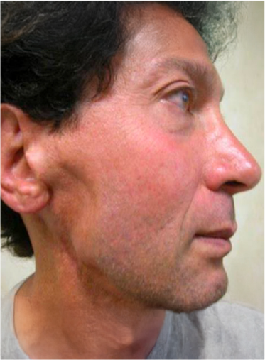 Stem Cell Lift case 3 before