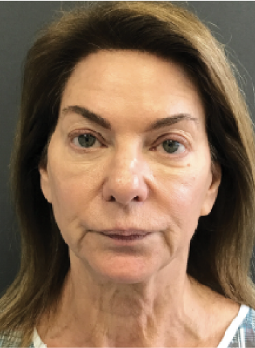 Stem Cell Lift case 4 before