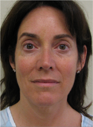 Stem Cell Lift case 6 before