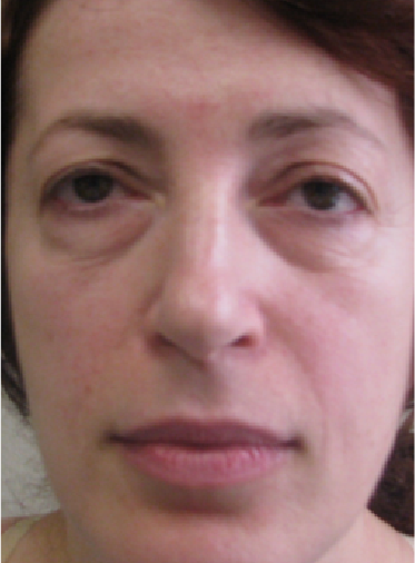 Stem Cell Lift case 8 before