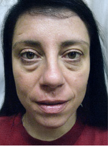 Stem Cell Lift case 9 before