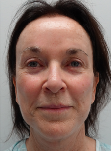 Stem Cell Lift case 10 before